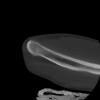 SPORK, NICO - 22.03.1976 - 02.08.2022 - CT obere Extremität - 17:59:38